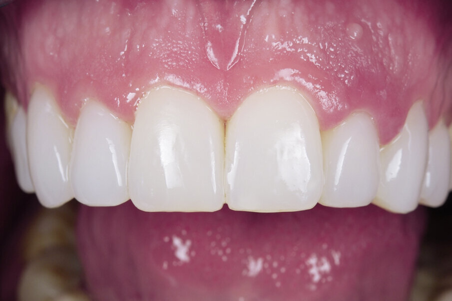 Fig. 19: Restoration with COMPONEER (first generation) 9 years ago