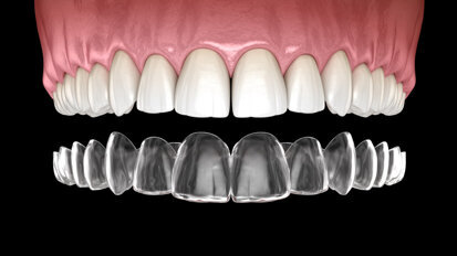 Pent-up demand helps Align Technology top pre-COVID-19 sales Pent-up demand helps Align Technology top pre-COVID-19 sales