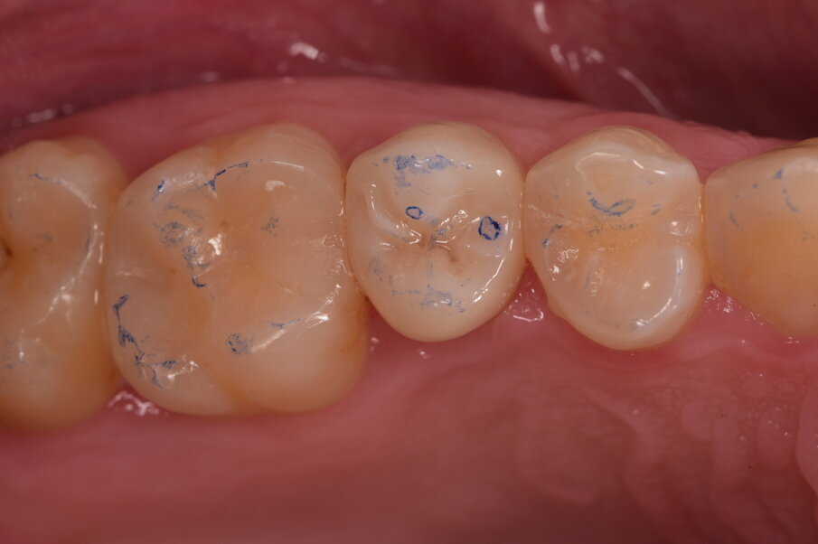 Fig. 16_Prova estetica e funzionale. Si notano i punti di contato di centrica evidenziati con la cartina a minimo spessore.