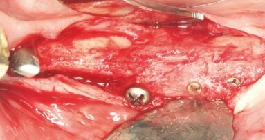 Augmentacja z wykorzystaniem indywidualnie frezowanego przeszczepu kości