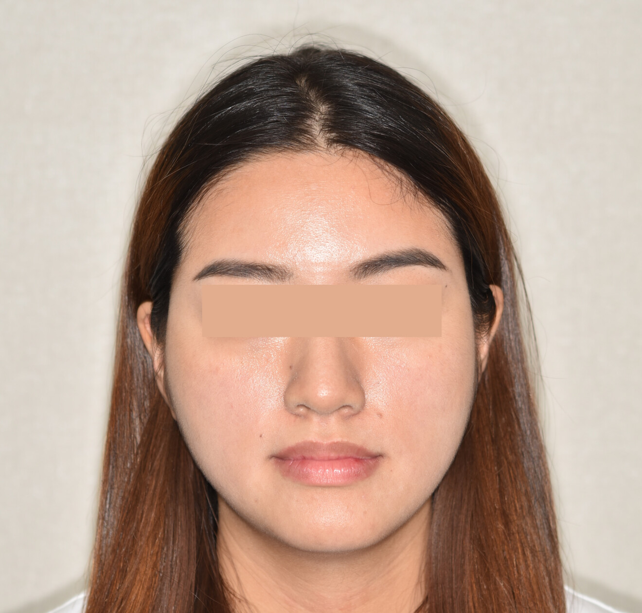 Figs. 1a–c: Initial extra-oral photographs.
