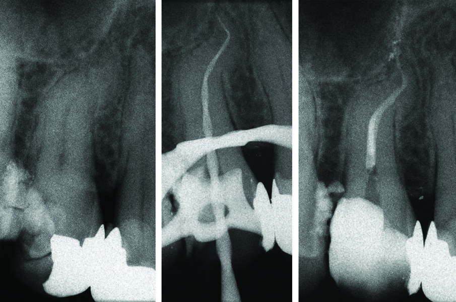 Fig. 10 - Terapia canalare 1.5 doppia curva il canale preparato manualmente con Mtwo.