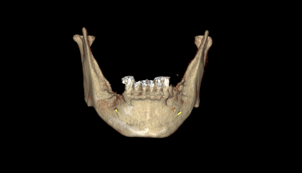 Fig. 2b: 3D reconstructions used for diagnostic assessment and treatment planning. Isolated CBCT reconstruction of the mandible.