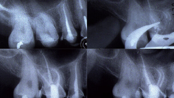 Vhodná technika vypracování apikální části kořenového kanálku