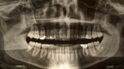 Chirurgen trekken 232 ‘tanden’ bij Indiase jongen