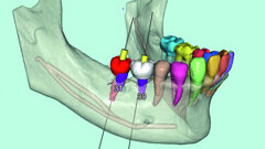 Flux de travail numérique et intelligence artificielle en implantologie