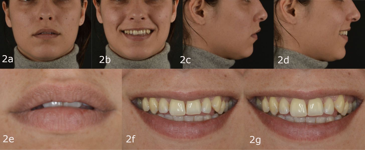 Figs. 2a–g: Pretreatment extra-oral photographs.