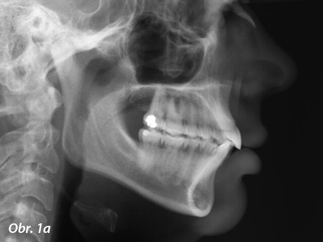 Pacientka 1 – Počáteční telerentgen a panoramatický rentgen.