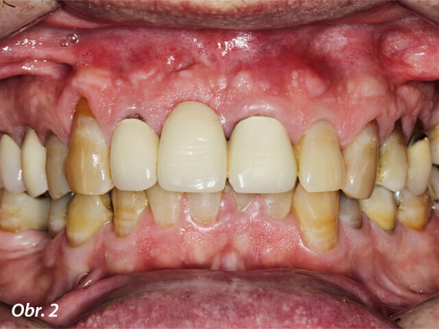 Intraorální frontální pohled v okluzi.