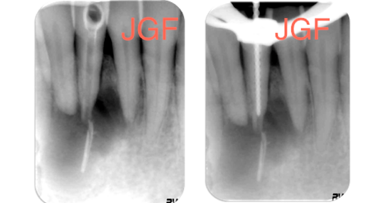 La reparación de la lesión apical compleja