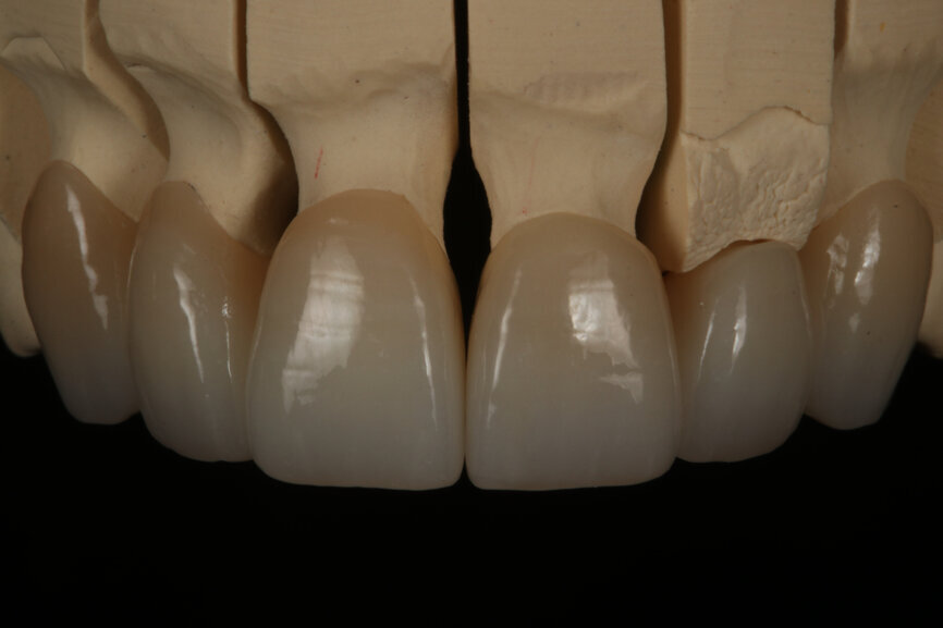 Fig. 13: Final outcome after glazing.