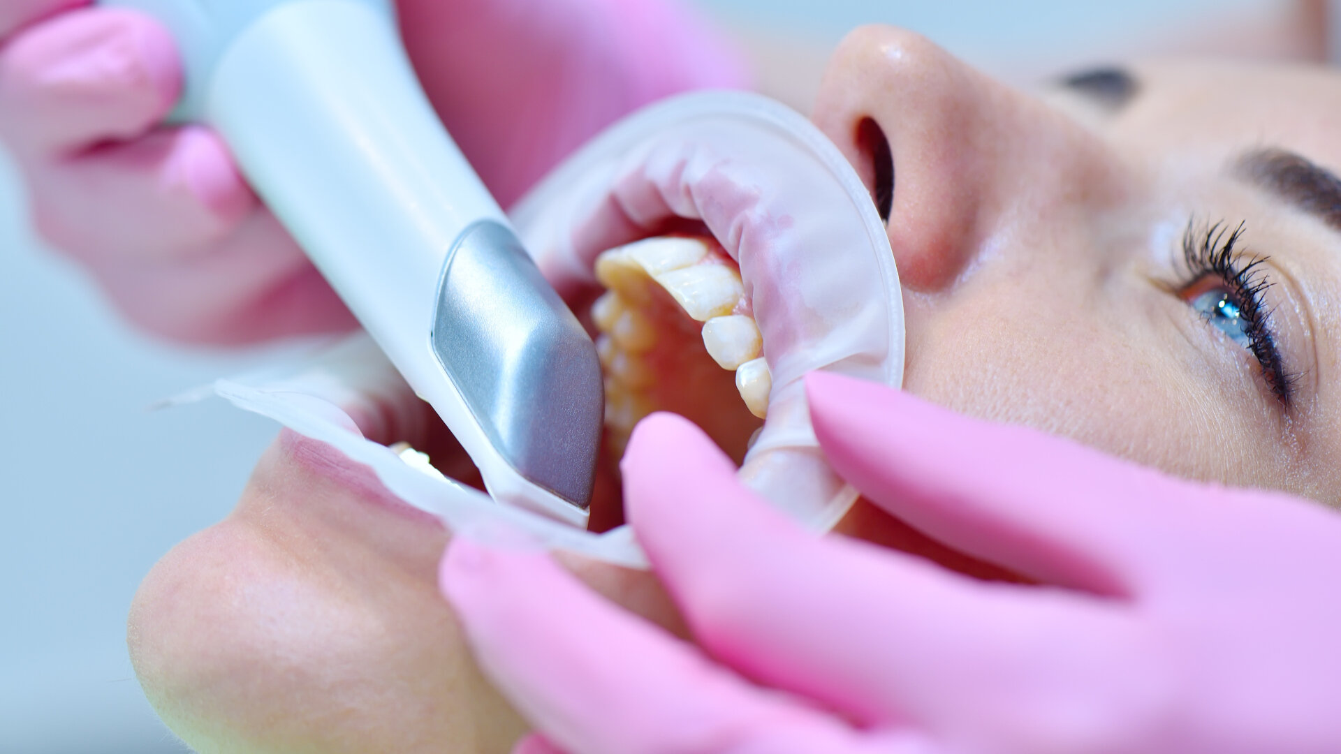 Intra-oral scanning: Current capabilities and ongoing developments