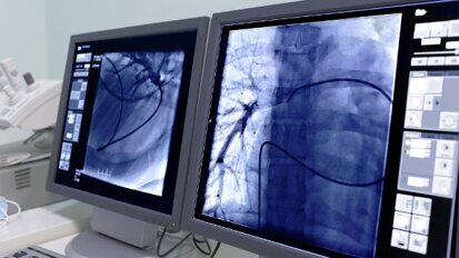 高危人群的定期肺癌CT扫描有助于头颈部癌症的早期诊断