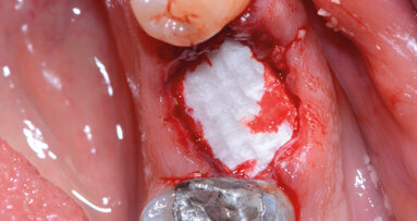 Ricostruzione della cresta in zona 3.6