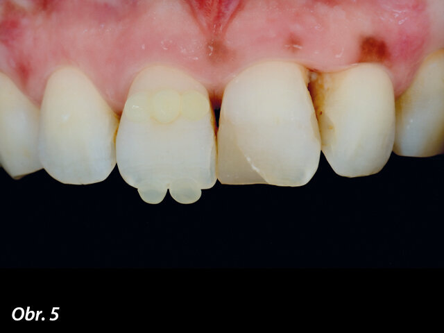 Výběr odstínu pomocí tzv. kompozitní „knoflíkové“ techniky (Composite Button Technique), s (4) a bez (5) polarizačních filtrů.