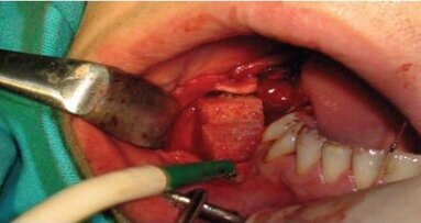 Metody augmentacji z wykorzystaniem czynników wzrostowych i komórek macierzystych