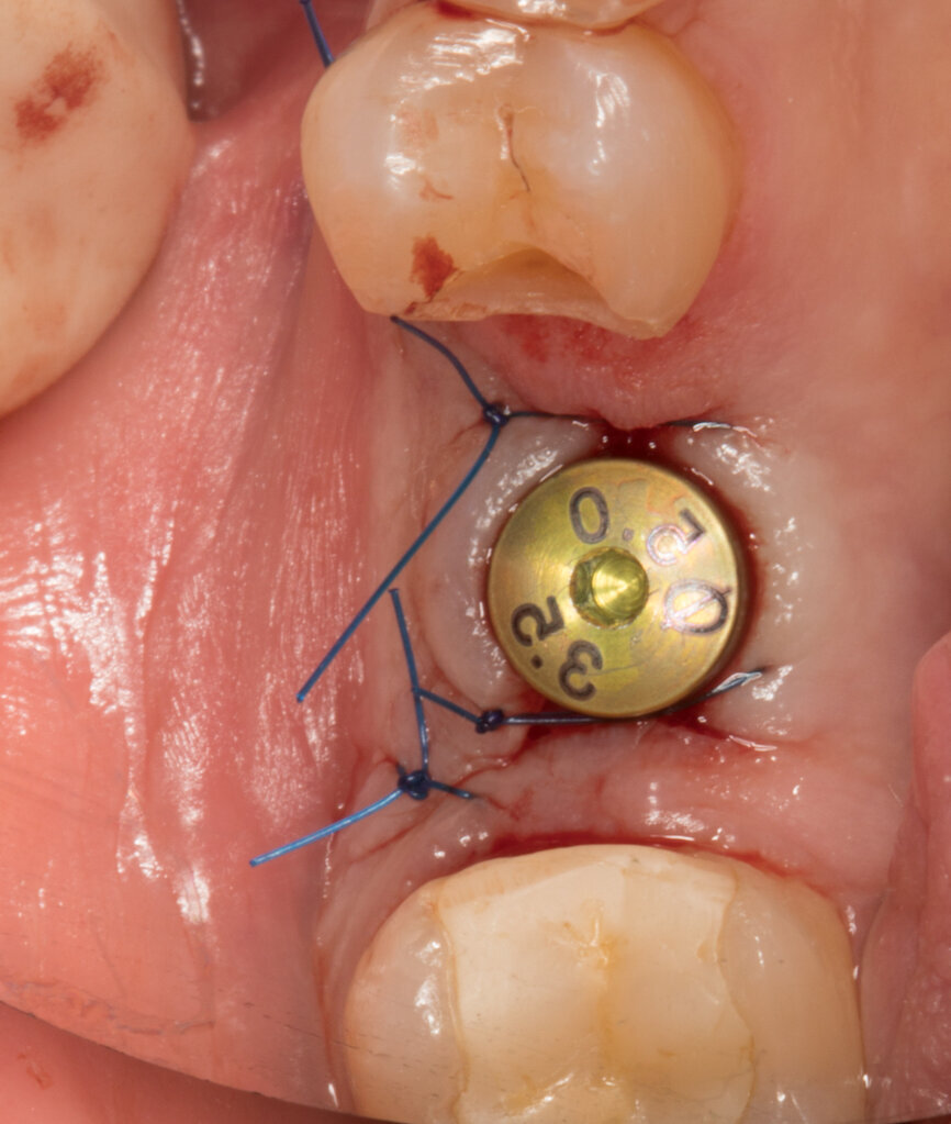 Ryc. 23-25_Dokręcona śruba gojąca na czas projektu i frezowania korony tymczasowej.