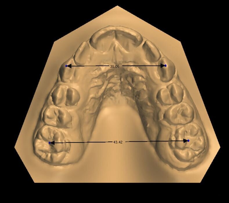 Fig. 6a_Misurazione distanza inter-molare e inter-canina a inizio terapia. 