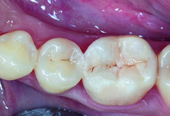 Fig. 13. After treatment - immediate post-op.