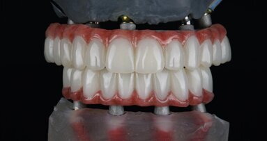 Ridefinire la riabilitazione full-arch: la rivoluzione del workflow digitale nell’implantologia