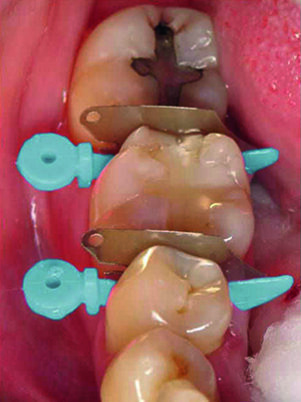 Insert Palodent® V31 WedgeGuard before starting preparation