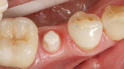 Komplexní řešení bez obsahu kovů: hybridní keramika a implantát z oxidu zirkoničitého