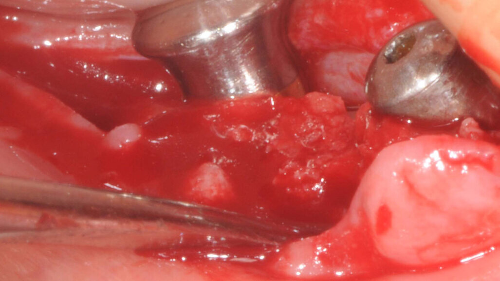 Restauro di un settore postero-inferiore atrofico con impianti extracorti da 4,5 mm di lunghezza