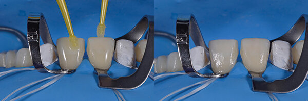 Fig. 16c. Aplicación del agente adhesivo.