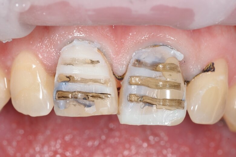 ig. 2 After producing the mock-up, grooves were prepared through the mock-up.