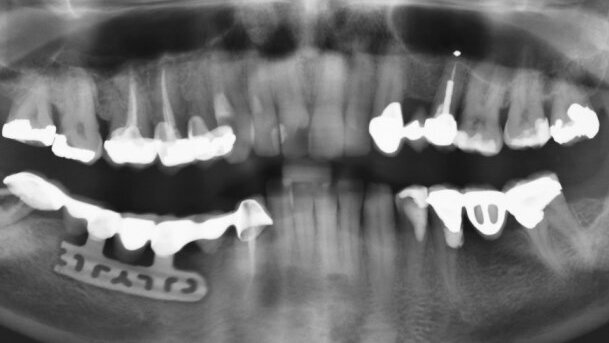 Implanty żyletkowe – relikt przeszłości czy pełnoprawna metoda terapii?