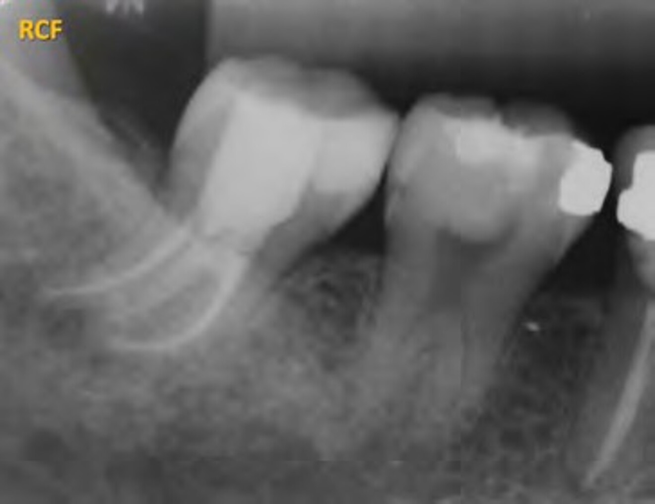 Fig. 1h: Postoperative radiograph demonstrating satisfactory obturation of the C-shaped root canal system and  successful completion of nonsurgical root canal treatment.