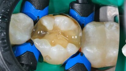 Tetric EvoFlow Bulk Fill: een tijdbesparende workflow