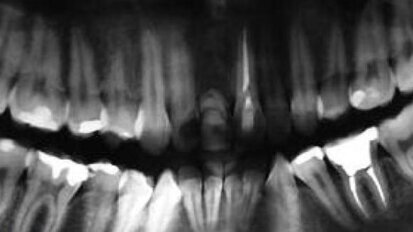 Przypadki rekonstrukcji implantoprotetycznej – obserwacje kilkuletnie