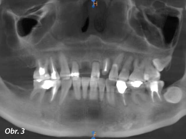 Obr. 3: Předoperační OPG snímek