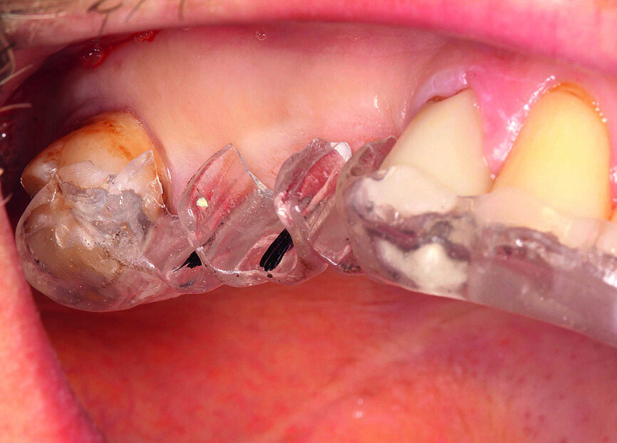 Fig. 5 : Essayage du guide de forage. 