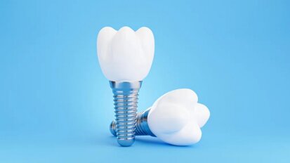 Výzkumníci vyvíjejí dentální implantáty na míru konkrétním pacientům
