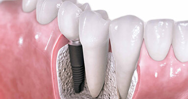 Десет факта за денталните импланти