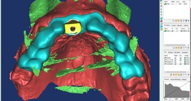L’Intelligenza Artificiale e la Realtà Aumentata nella moderna pianificazione implantare: case report
