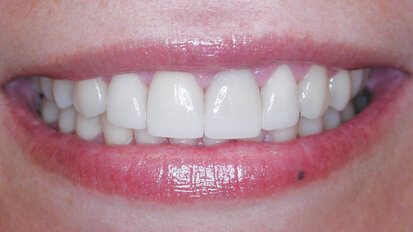 Making a single veneer blend so naturally it’s undetectable