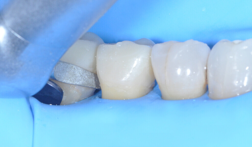 Fig. 25: Finishing of the buccal and lingual margins with a medium-grit flame-shaped diamond bur. 