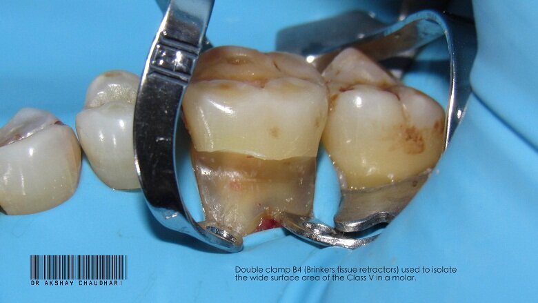Fig - 13 Class V lesion isolaion