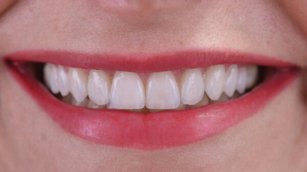 Fig. 17d. Amplia sonrisa.