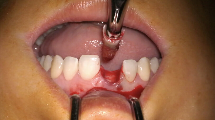 Fig. 11_Estrazione del dente 1.1.