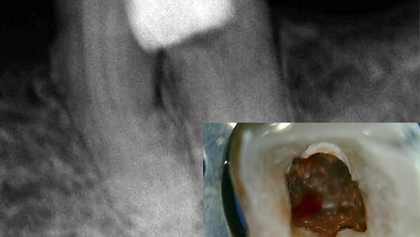 Tratamiento de perforación con el nuevo MTA Repair HP