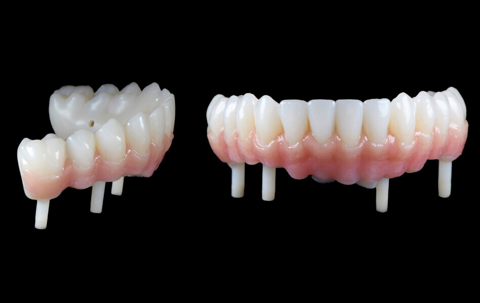 Fig. 8: Provisional prosthesis of PMMA and pink composite resin.