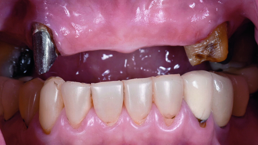 Fig 6. Pre-operative without 9-unit FDPs
