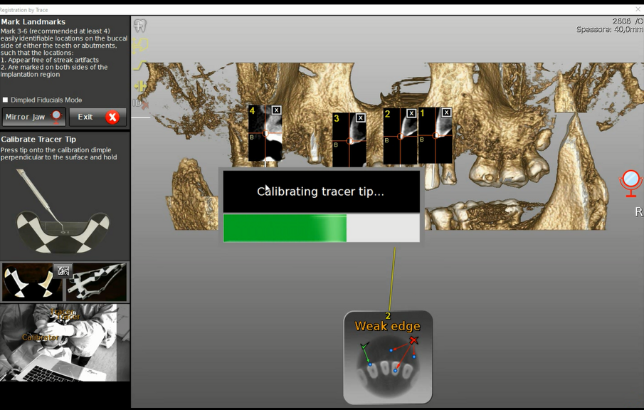 Figg. 6a-6d - Tracciatura della superficie di riferimento in tempo reale. a) Calibrazione del tastatore; b) Selezione dei denti e dei punti di partenza della scansione per tastatura; c) Fasi di scansione (tracer registration); d) Dettaglio clinico della procedura di tracer registration.