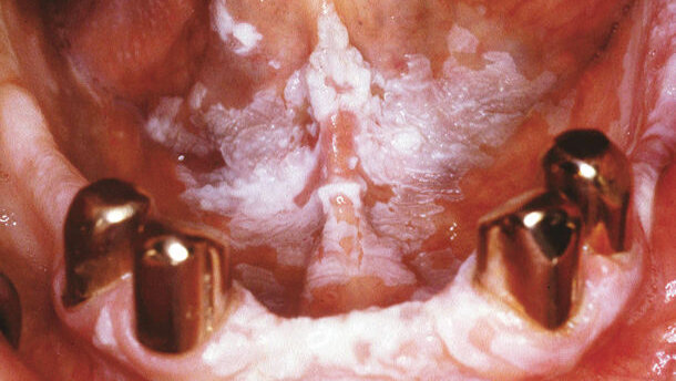 Die Rolle des Geschlechts bei prämalignen Erkrankungen der Mundschleimhaut