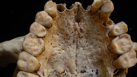 Grave paraodontopatia con reazione ossea paradontale associata a deficit vitaminico in stati carenziali