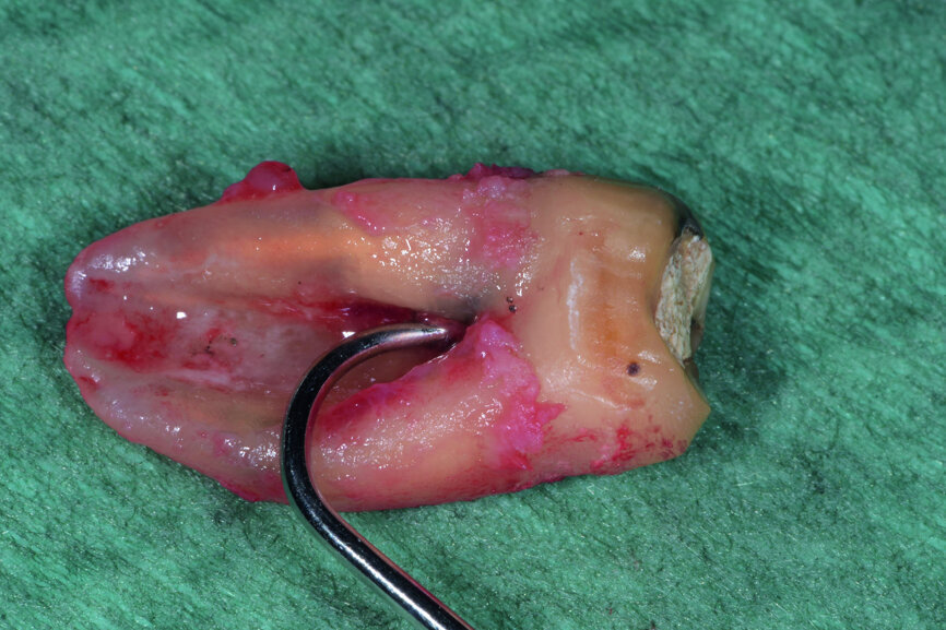 Fig. 12: Pulp chamber floor perforation, immediately after extraction.